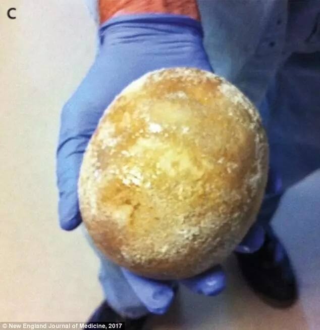 The massive bladder stone. Photo: New England Journal of Medicine 2017