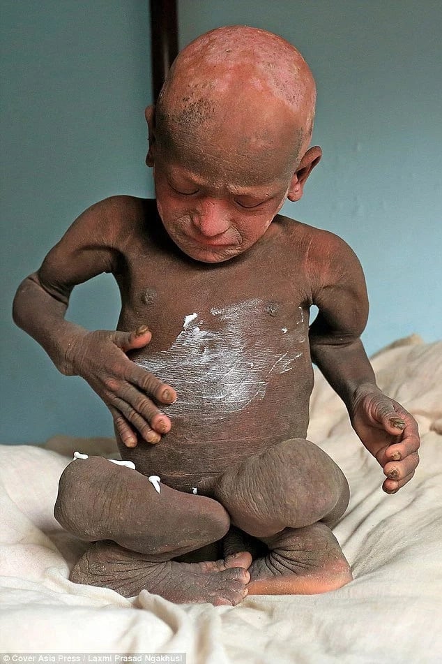 Boy suffers from odd skin disorder that turns him into stone