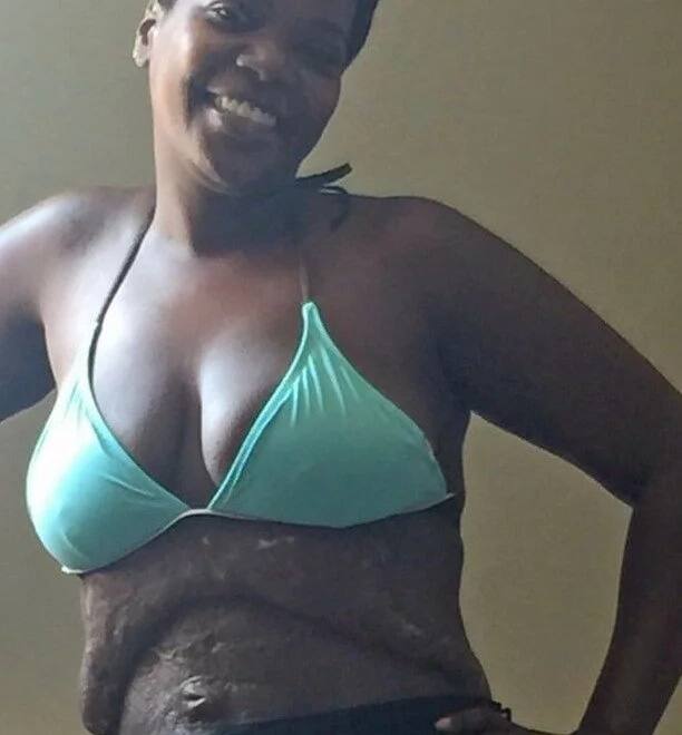 Mother's botched tummy tuck surgery leaves her DEFORMED MUSHROOM stomach (photos)
