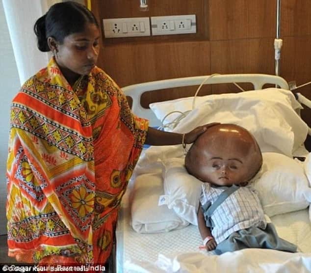 Baby born with hydrocephalus undergoes life-saving operation