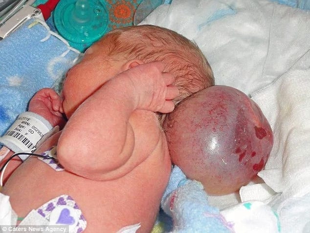 Girl born with brain growing outside her skull survives