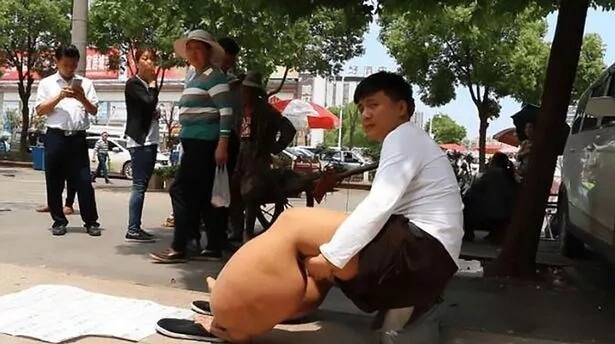 He wants to survive! Doctors told this man with legs SEVEN times their size he would not live past 20 (photos)
