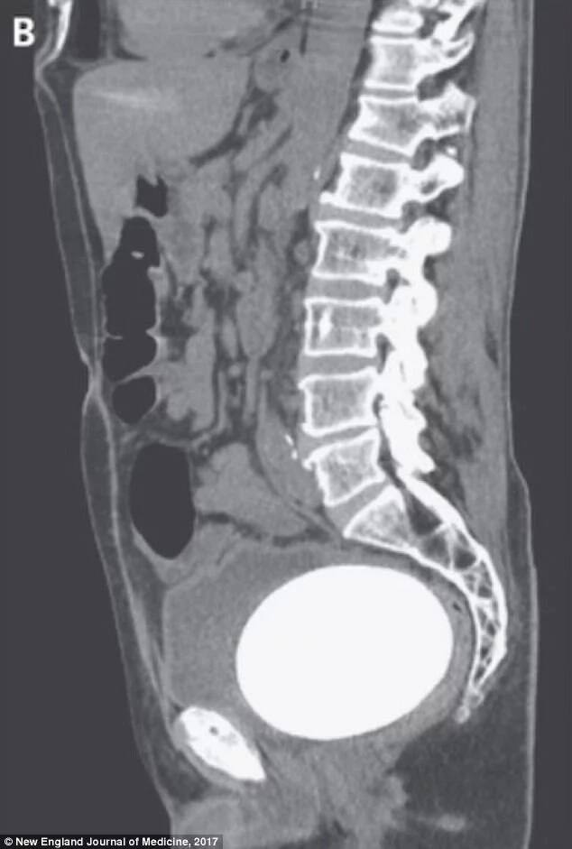 An X-ray image of the bladder stone in the man's body before it was removed. Photo: New England Journal of Medicine 2017
