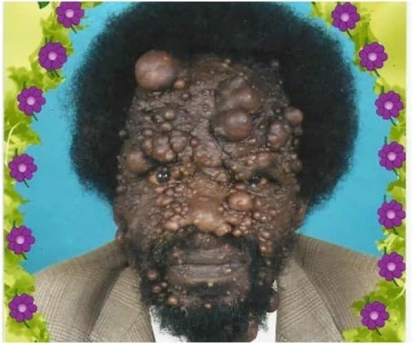 Nyeri pastor with mysterious skin disease winning people of God