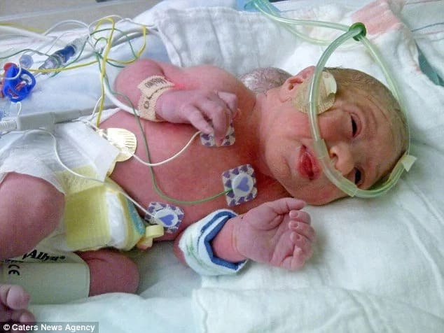 Girl born with brain growing outside her skull survives