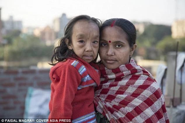 Children look like pensioners due to rare aging disorder