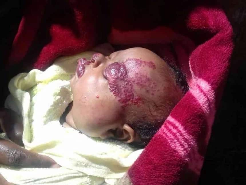 Meet this two months Samburu baby with bleed oozing from her mouth and with swollen eyes