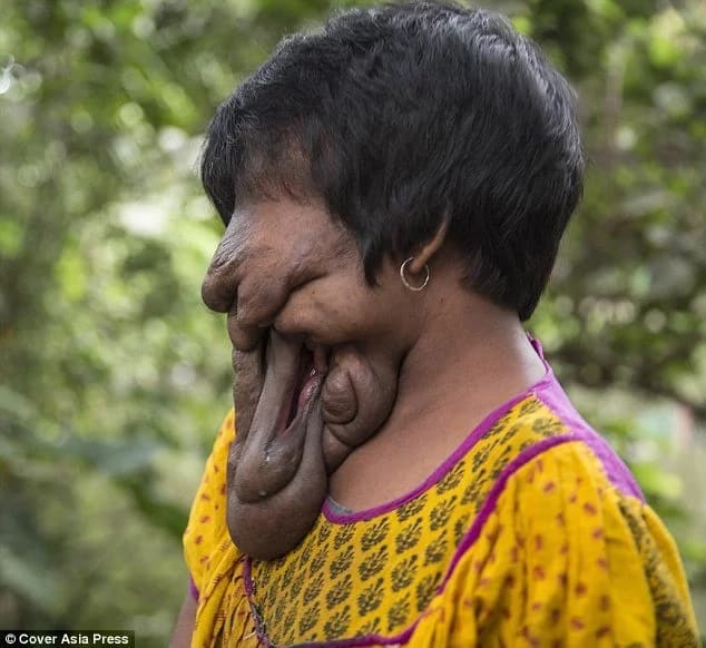Woman With No Face To Undergo Life-Changing Operation