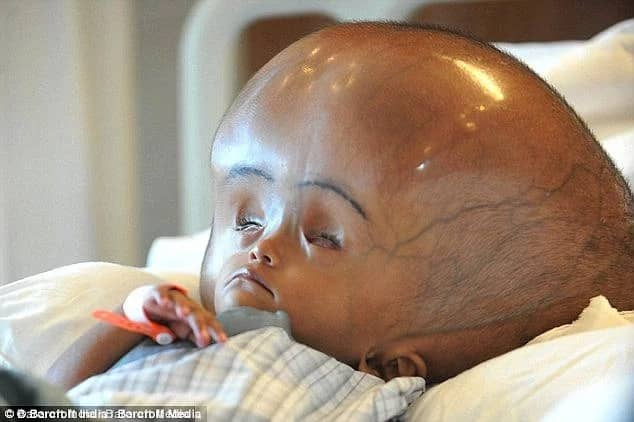 Baby born with hydrocephalus undergoes life-saving operation