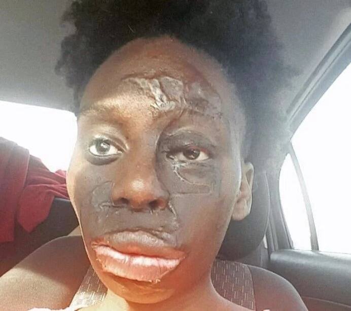 Meet burns survivor, 25, who wears her flaws like diamonds and rejects surgery (photos)