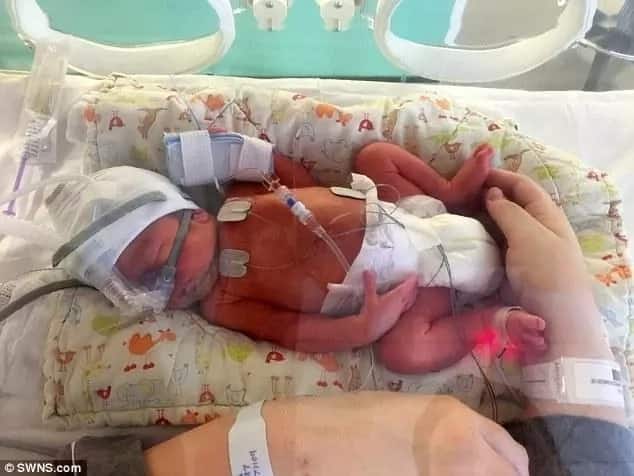Heartbreaking decision! Couple expecting triplets forced to sacrifice conjoined twins to save one