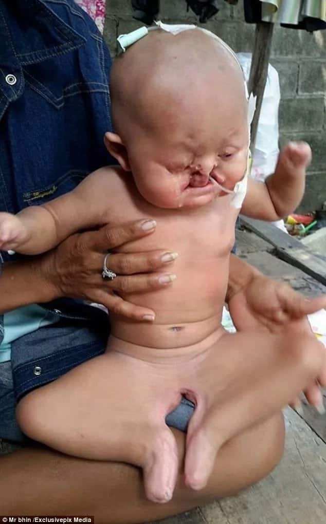 Doctors unable to determine gender of MERMAID baby who suffers from this rare deformity (photos)