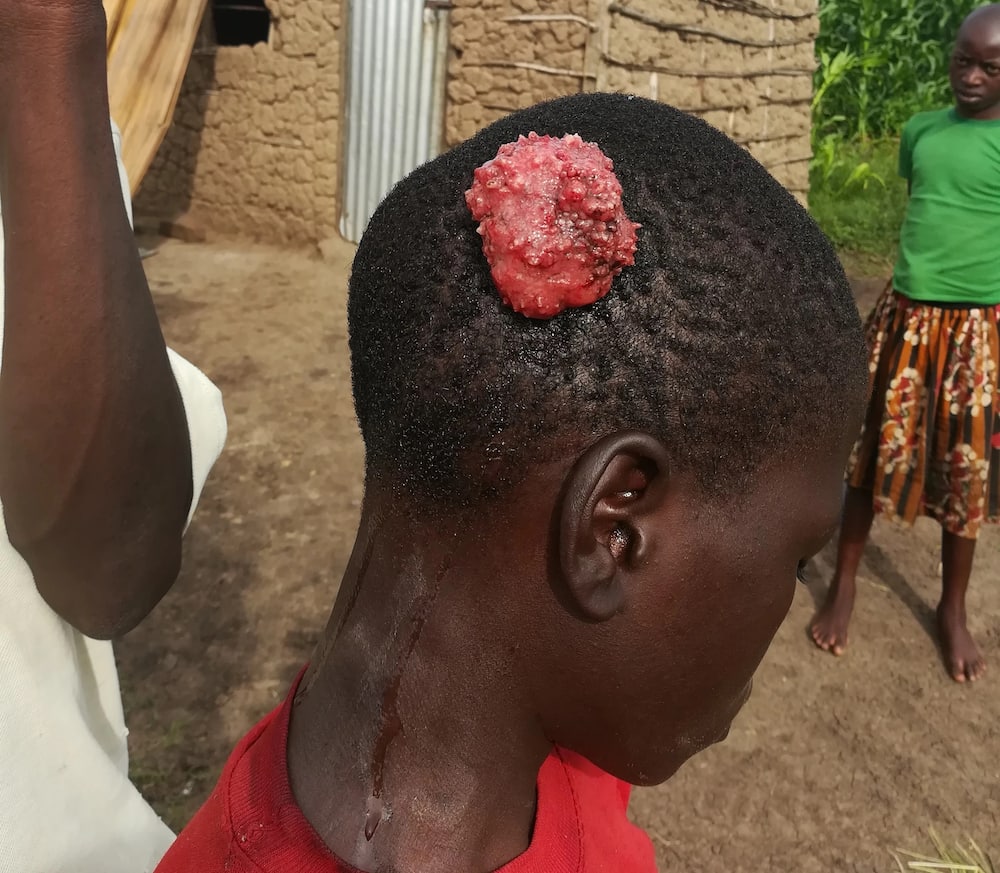 14-year-old Homa Bay boy cries for help to remove head tumour