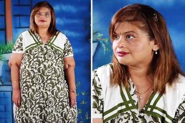 India’s FATTEST woman, who weighed 298kg and was bedridden for 8 years, gets new life after surgery (photos)