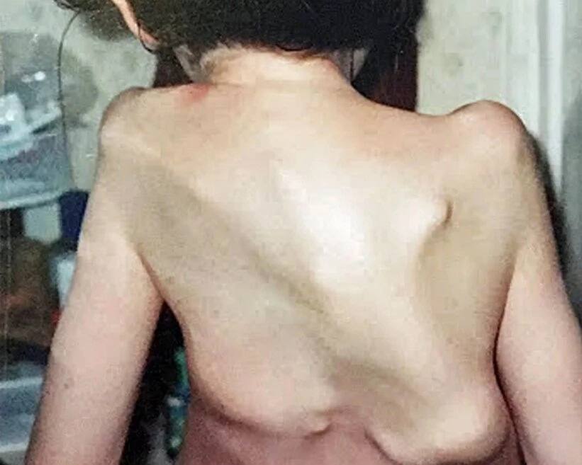 Rare congenital condition causes woman's muscles to turn to BONES (photos)