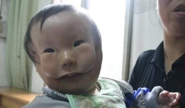 Story of boy born with 2 faces will break your heart (photos, video)