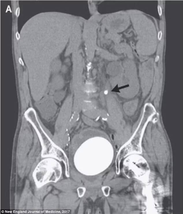 Doctors noticed another smaller bladder stone. Photo: New England Journal of Medicine 2017