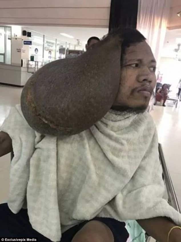 Relief for man who carried a tumour TWICE the size of his head as doctors remove it (photos)