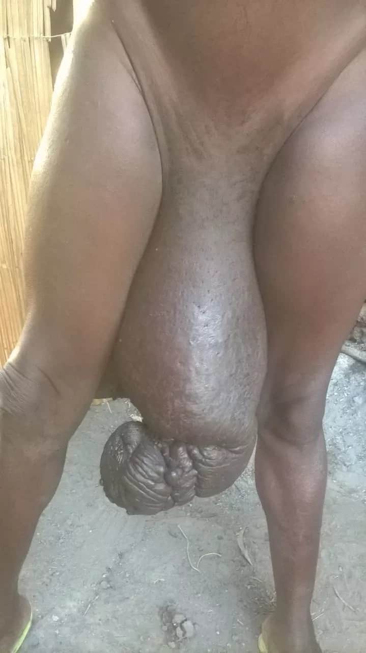 Kisumu man with strange illness that has manhood 10 times its size