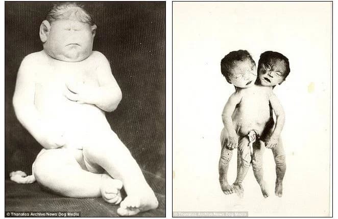 Freak show! New archive of 19th century images show people's OBSESSION with physical deformities