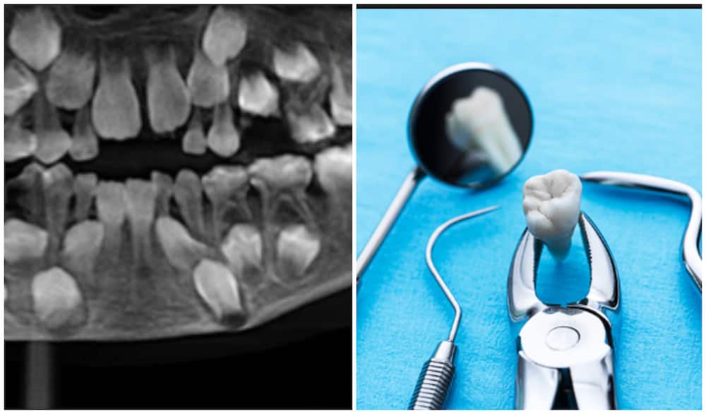 Doctors find 526 teeth in 7-year-old boy's mouth
