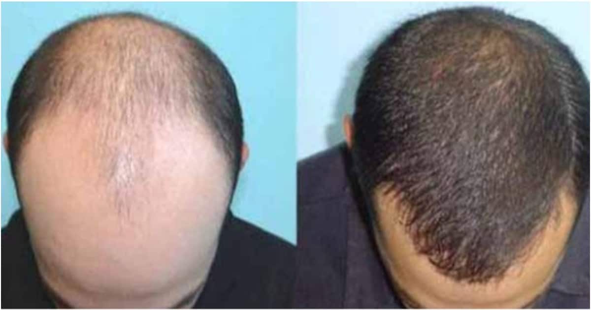 Experts introduce painless, permanent solution to hair loss in Kenya