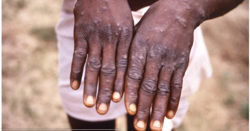 Monkeypox: Signs, Symptoms and Key Facts About Fast-Spreading Virus