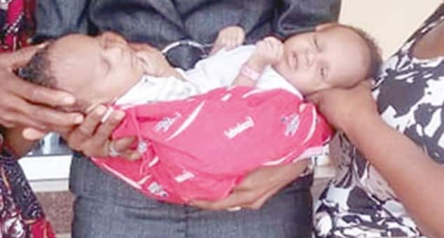 Man abandons wife after she gave birth to conjoined twins