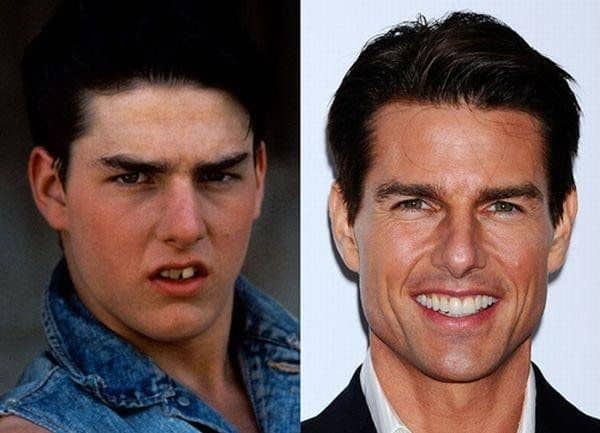Tom cruise's teeth before and after