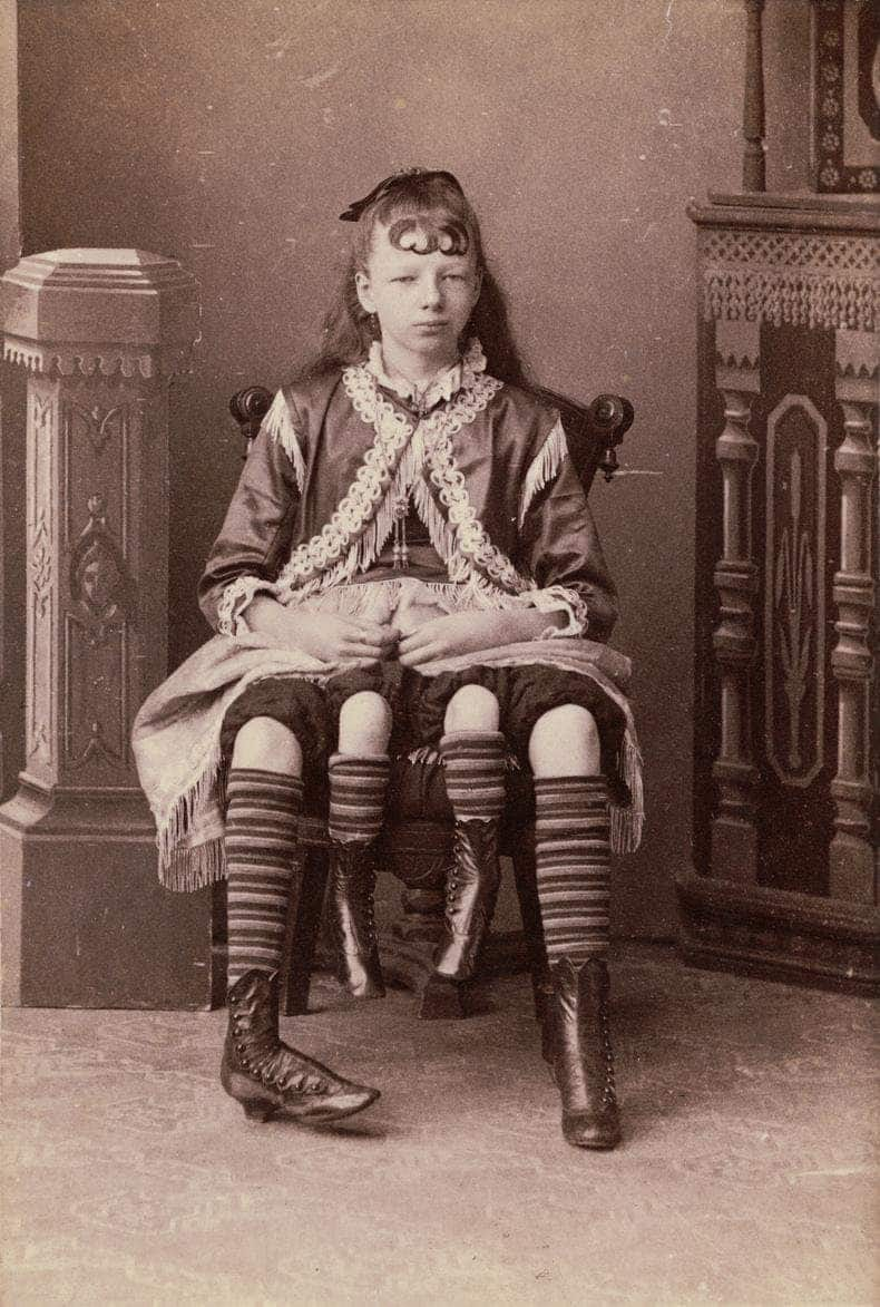 Josephine Myrtle Corbin, "the 4-legged woman": her story, facts, and photos