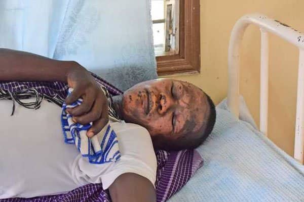 KCSE 2019: Candidate burnt as chemical explodes on his face during practical exam