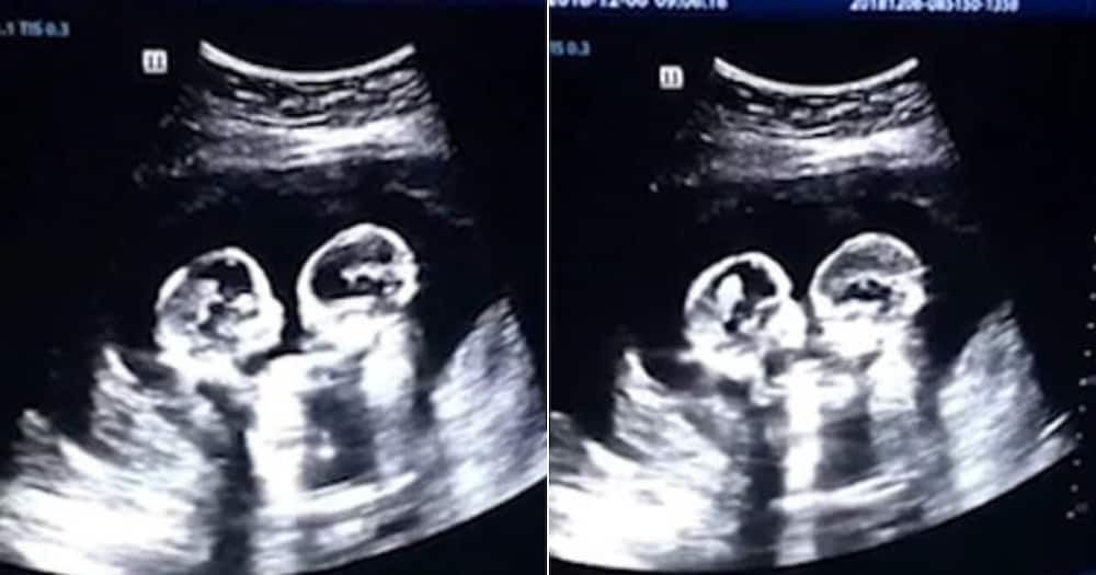Ultra sound scan shows twin sisters fighting inside mother's womb