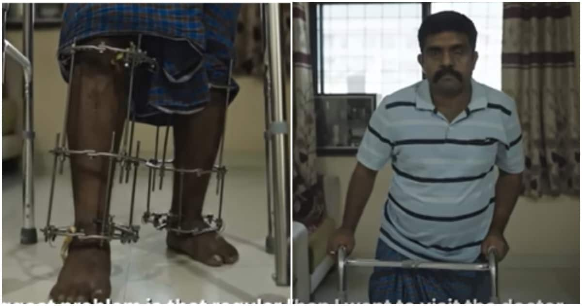 Indian man taunted for his height breaks bones to grow taller