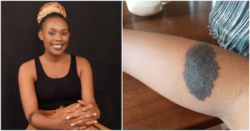 Lilian Mbithi, huge birthmark on hand.