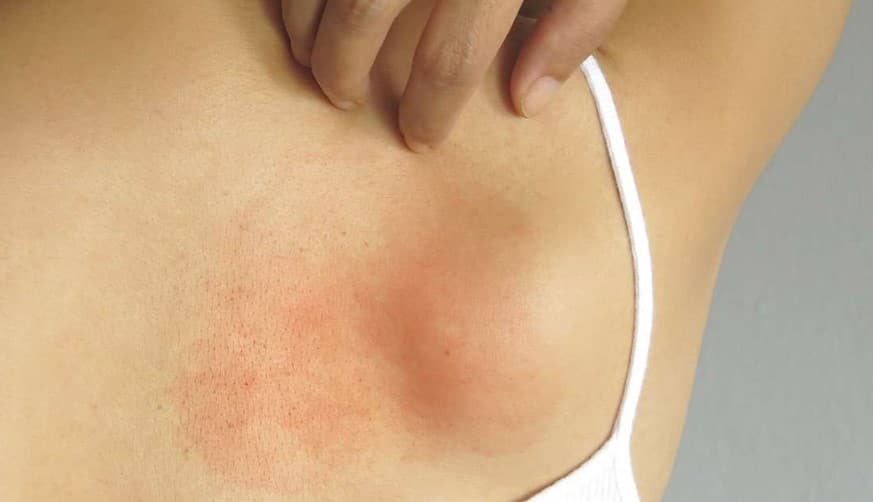 Chlorine Rash & Swimmer's Itch: Pictures, Symptoms, & Treatment