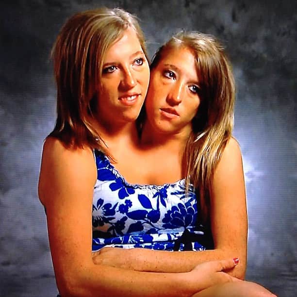 Conjoined twins Abby and Brittany Hensel married