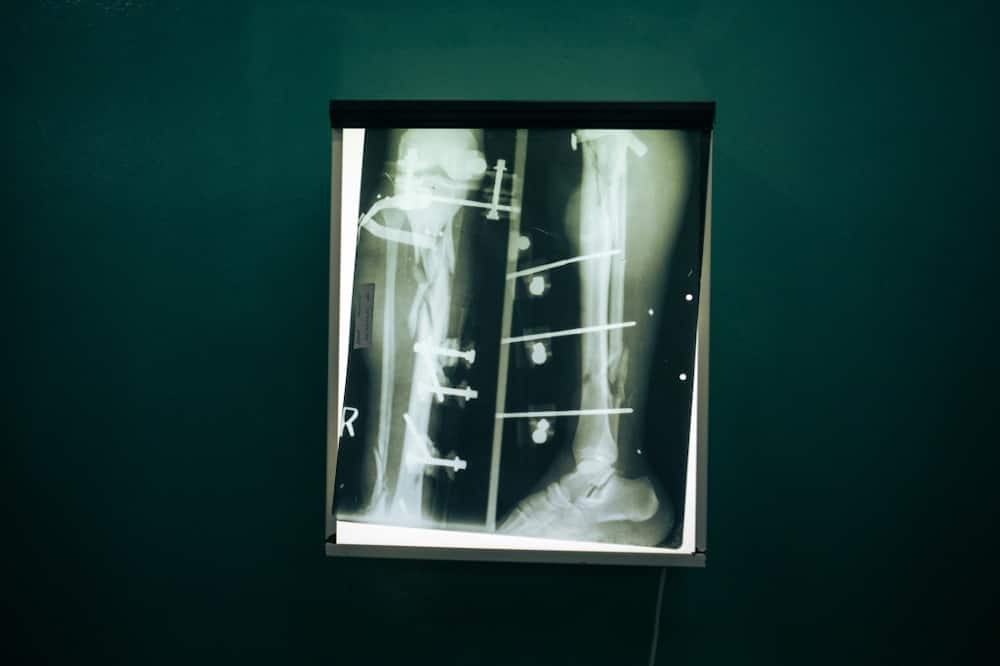 An X-ray of a wounded Congolese soldier's leg