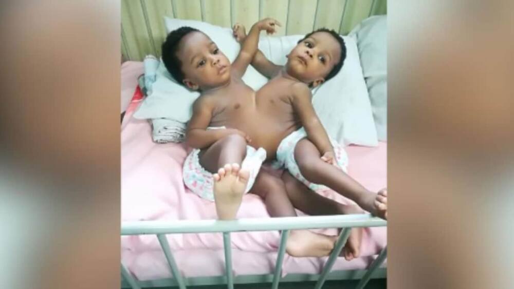 Nigerian doctors successfully separate conjoined twins in Abuja (photos)