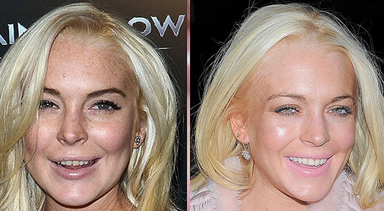 bad celebrity veneers