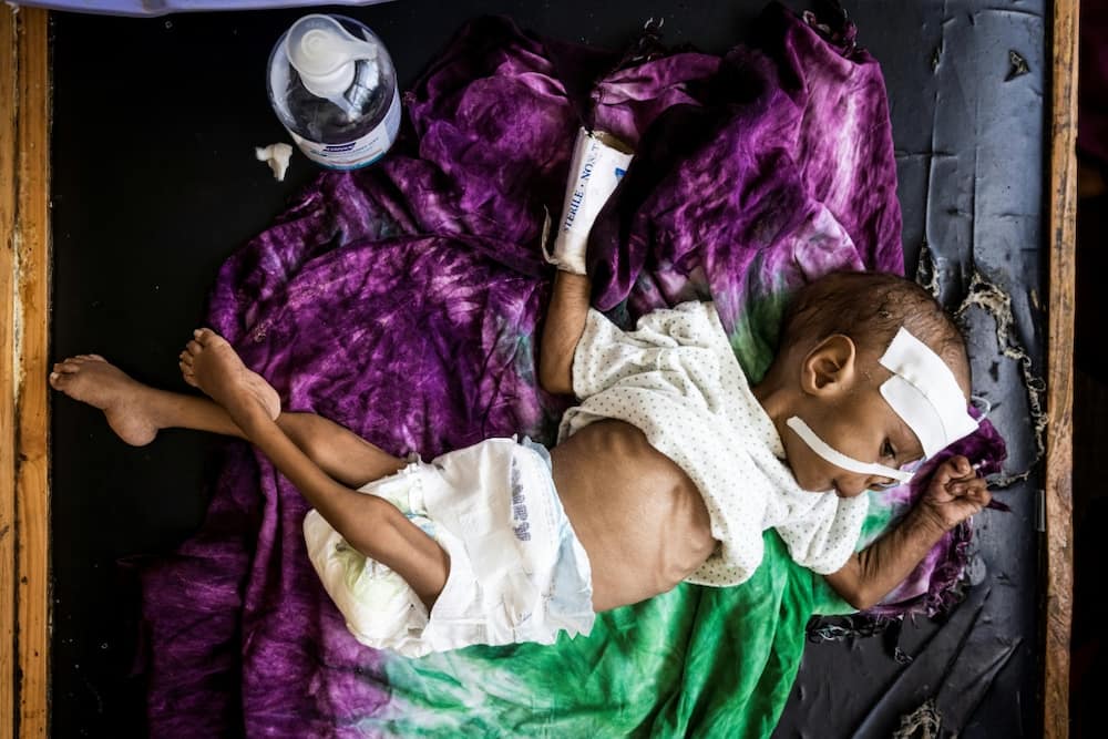 Hunger: A severely malnourished baby at the Banadir Maternity and Children Hospital in Mogadishu, Somalia