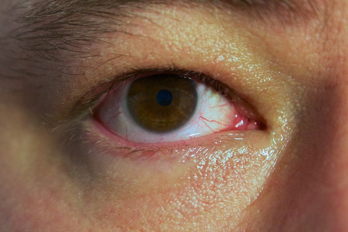 Download Red eyes: causes, symptoms and treatment Tuko.co.ke