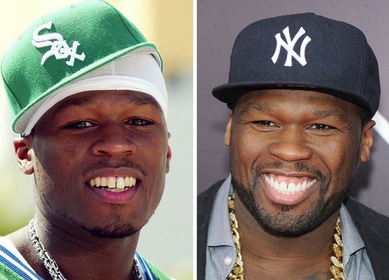 black celebrities with bad teeth before and after