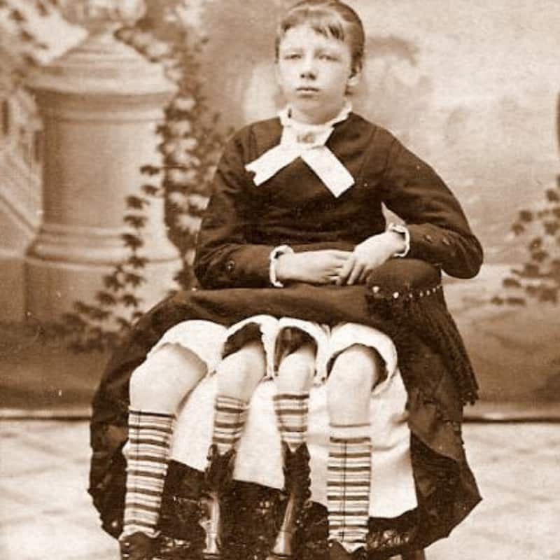 Josephine Myrtle Corbin, "the 4-legged woman": her story, facts, and photos