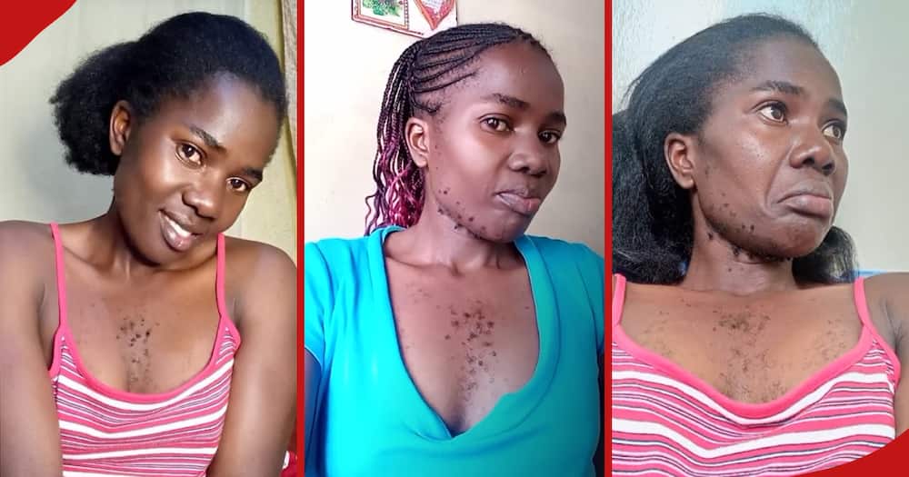 Kenyan woman with a beard and chest hair urges women with hirsutism to embrace it.